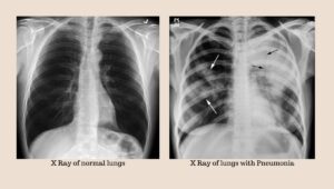 white lung syndrome